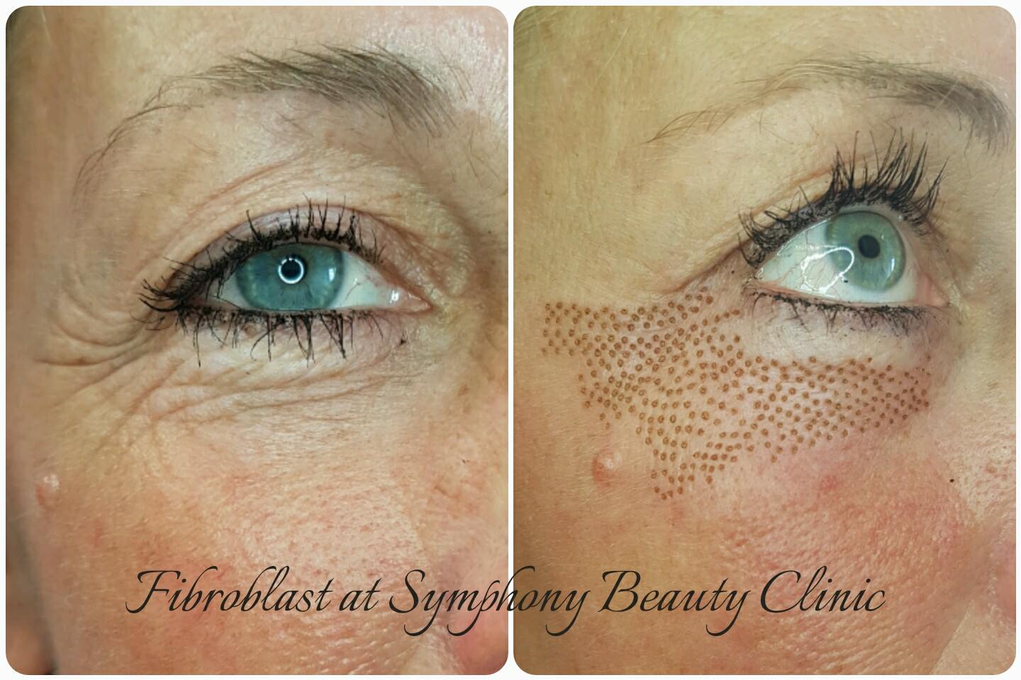 Fibroblast skin reduction lower eyelid - Symphony Beauty ...